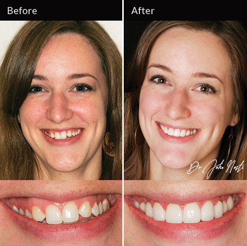 10 veneers