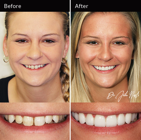 10 veneers