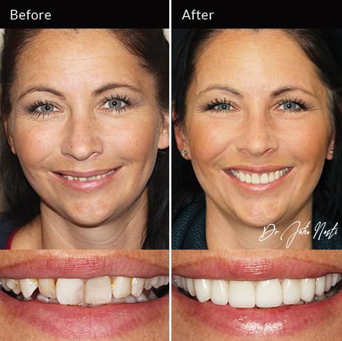 10 veneers