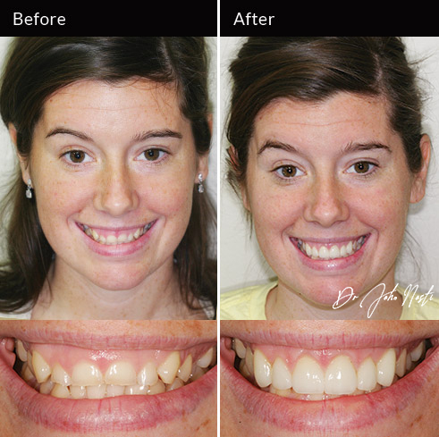 Gum surgery and veneers