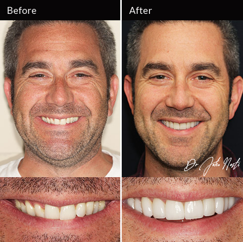 10 veneers