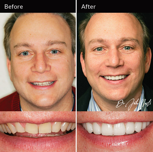 10 veneers