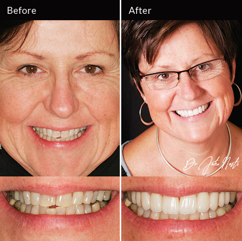 10 veneers