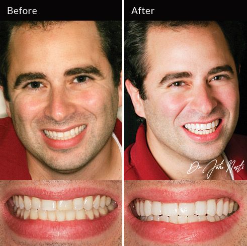 No prep veneers