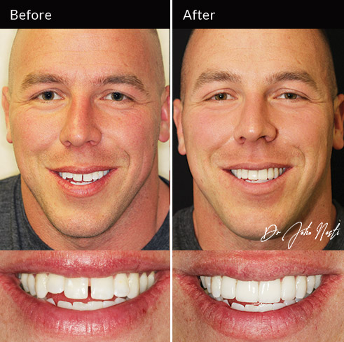 4 veneers