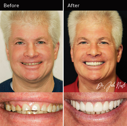 10 veneers