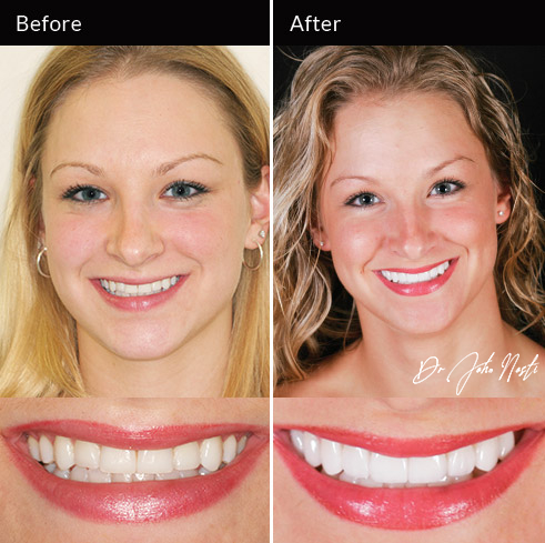 No-prep veneers