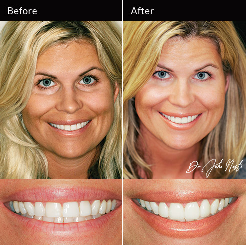 4 veneers