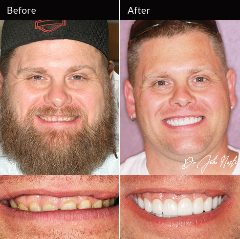 Full-mouth rehabilitation