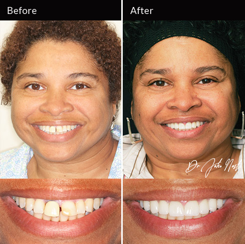 10 veneers