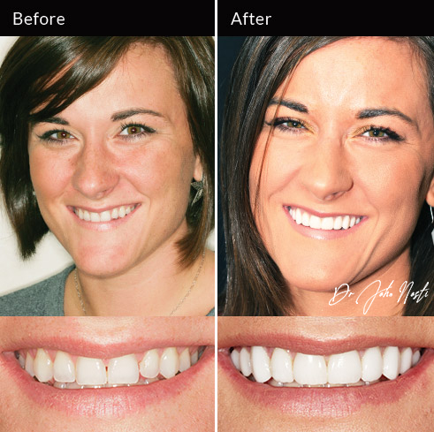 No-prep veneers