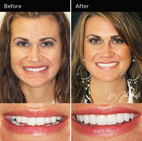 10 Minimal-prep veneers