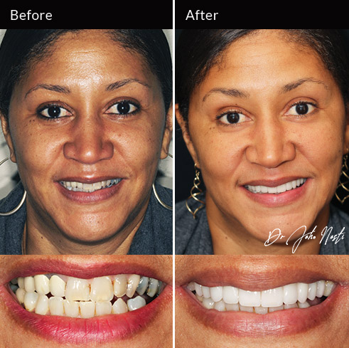 10 veneers