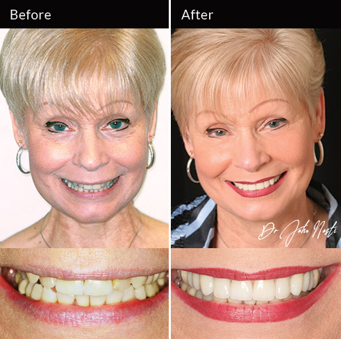 10 veneers