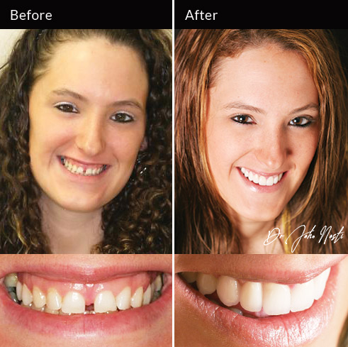 Veneers and gum recontouring