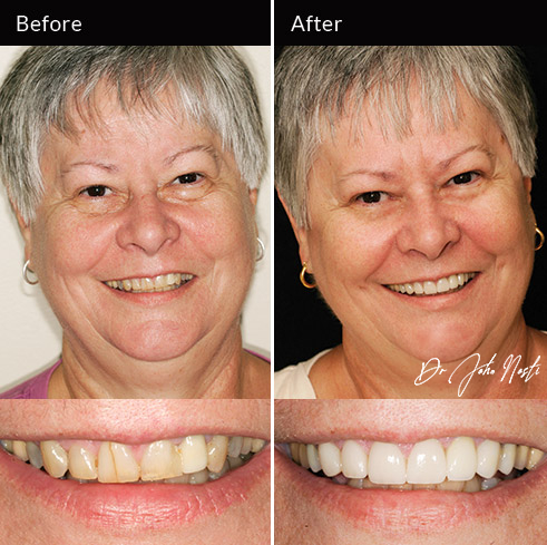 8 veneers