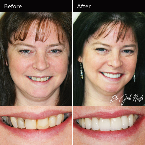 10 unit veneers