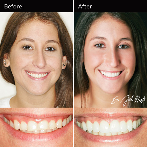 10 veneers