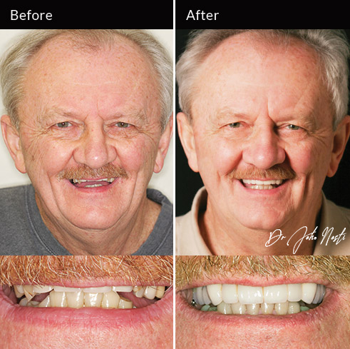Maxillary bridgework