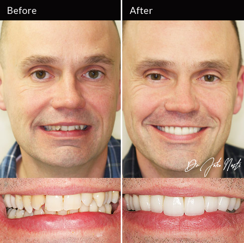 Maxillary veneers