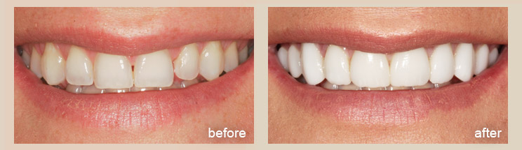 Porcelain Veneers - Advanced Cosmetic Dentistry