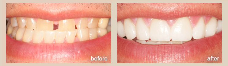 Porcelain Veneers