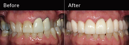 al-teeth-test