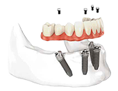 Dental Implants