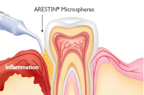 Cleanings & Gum Disease Treatment 