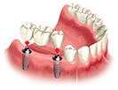 Options For Replacing Missing Teeth