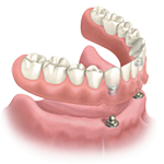 Options For Replacing Missing Teeth