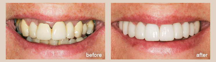 Dental Implants - Advanced Cosmetic Dentistry