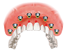 Options For Replacing Missing Teeth