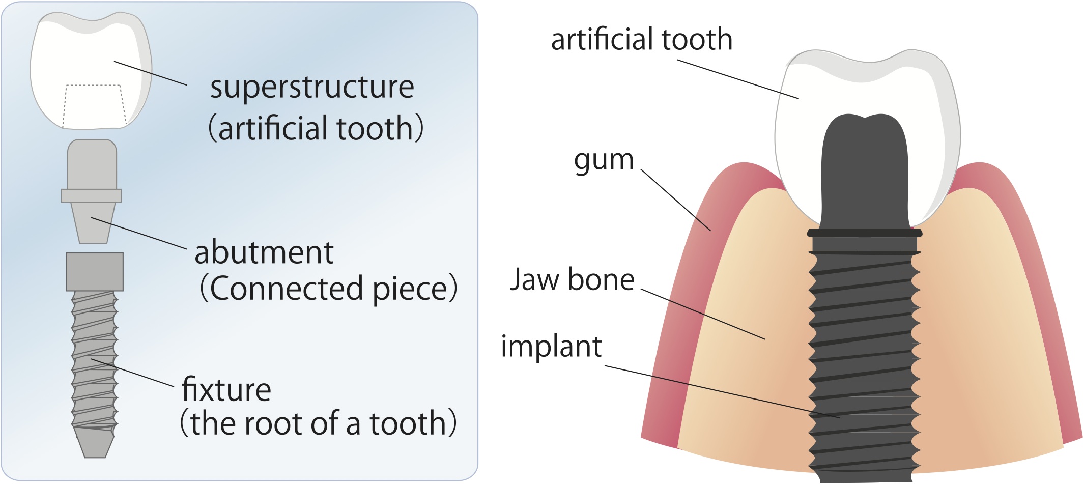 Dental Implants