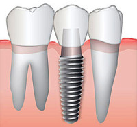 Dental Implants