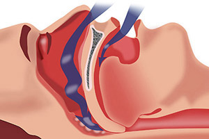 Sleep Apnea & Snoring Treatment