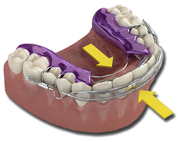 Teeth Straightening